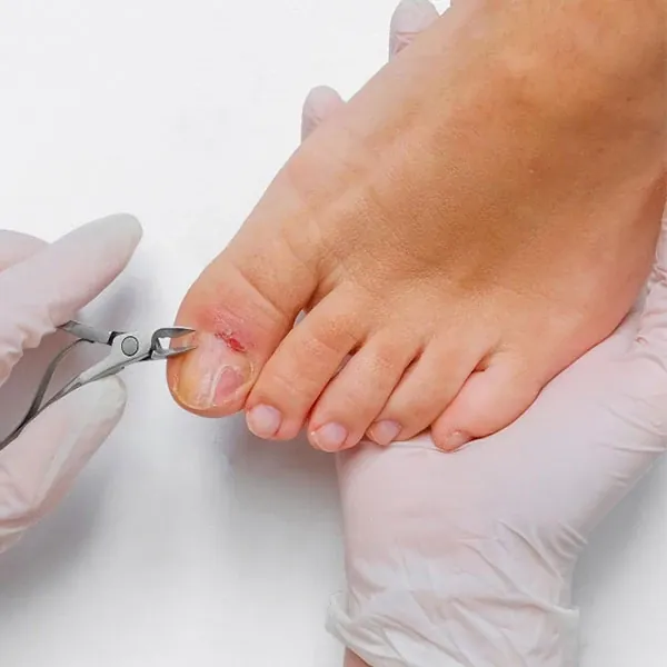 Fußnägel werden in der Podologie-Praxis fachgerecht mit der Nagelzange gekürzt