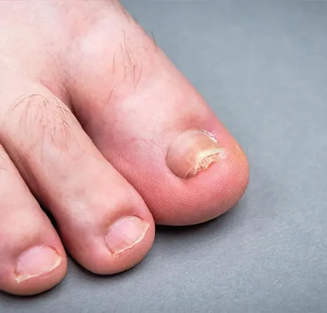 Verfärbter Großzehennagel bei Nagelpilz vor der Behandlung